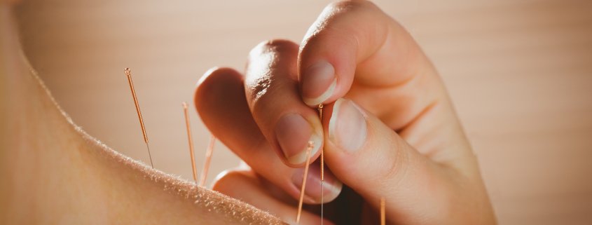 Newmarket Acupuncture Therapy Newmarket