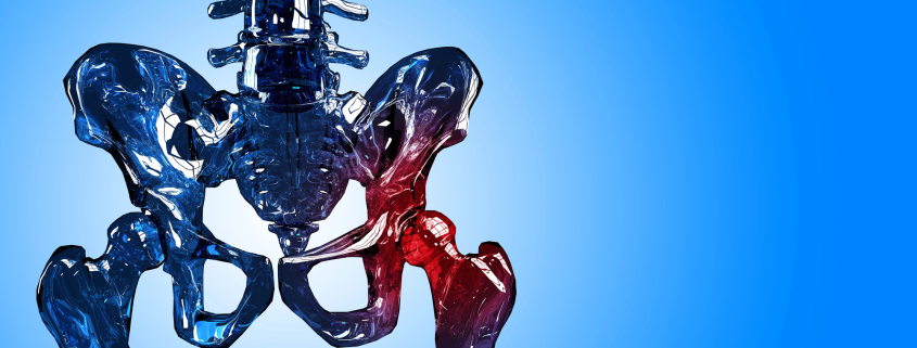 Physio after hip surgery