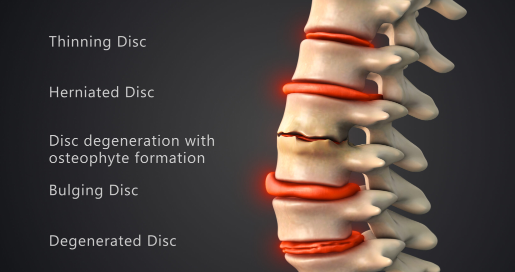Degenrative disc disease